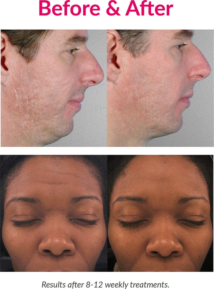 PMD Personal Microderm Classic Device – At - Home Microdermabrasion Tool Exfoliation Kit NEW Authentic - Give + Glow