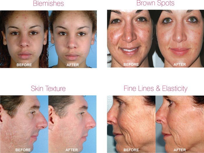 PMD Personal Microderm Classic Device – At - Home Microdermabrasion Tool Exfoliation Kit NEW Authentic - Give + Glow